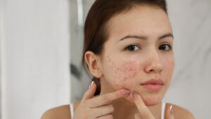  Woman with Acne on Her Face 